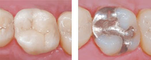 Tooth with a metal filling next to a tooth with a metal-free, composite filling.