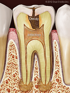 Tooth diagram outlining how decay and infection cause root canal problems.