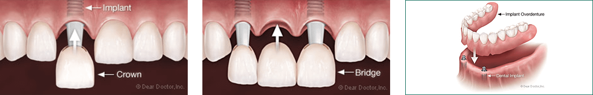 Diagrams of dental implants, dental crowns, dental bridges, and implant-supported overdentures.