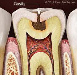 Tooth diagram showing a cavity in need of a composite filling.