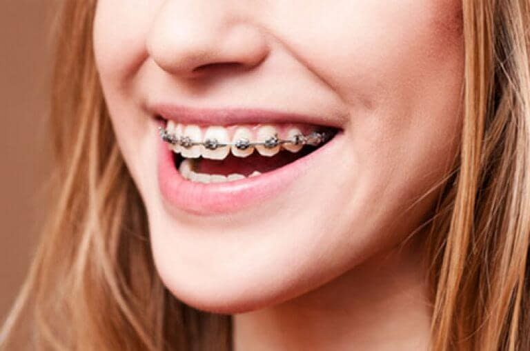 Why You Should Wear Your Retainer After Braces.