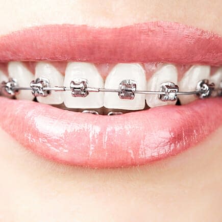 Braces 101 - New Braunfels Braces