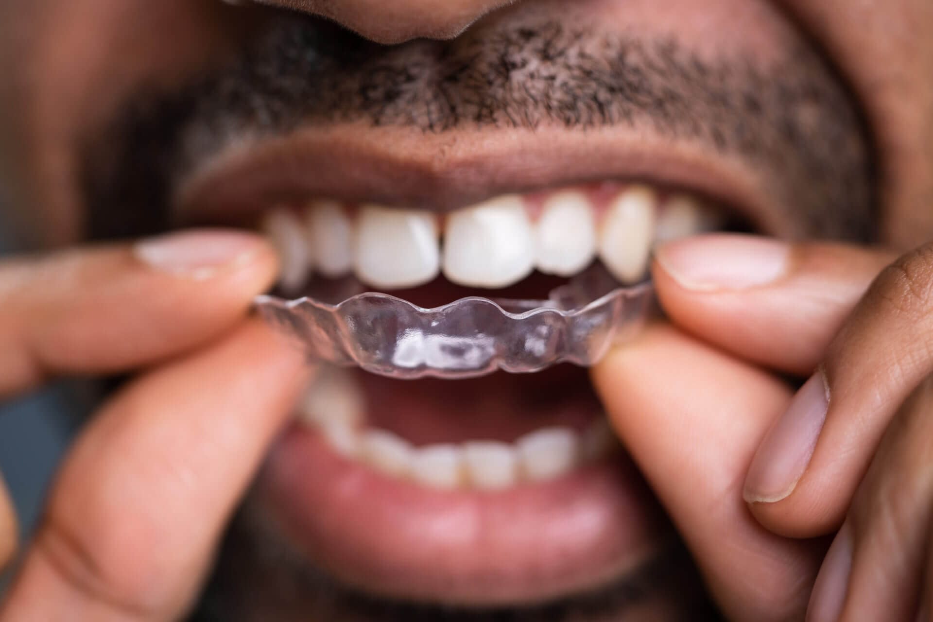 How Do Clear Aligners Straighten My Teeth?