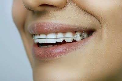 teeth retainer