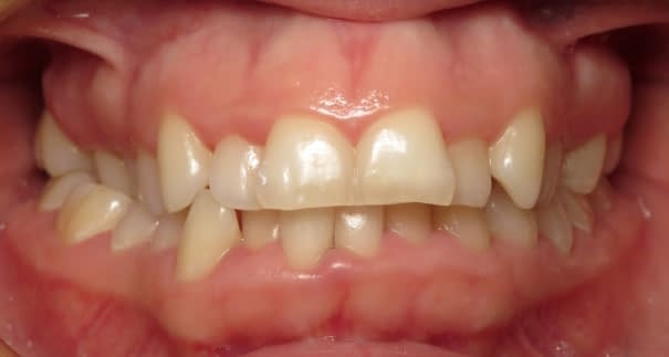 LY15-Initial-Examantocclusal-1 Vermette Orthodontics