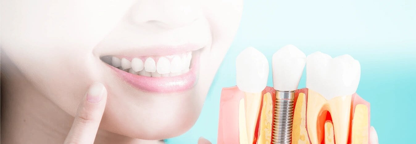 Dental Implants