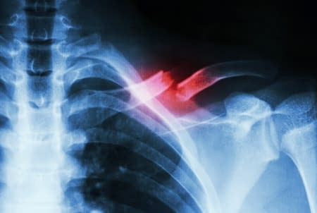 broken-collar-bone