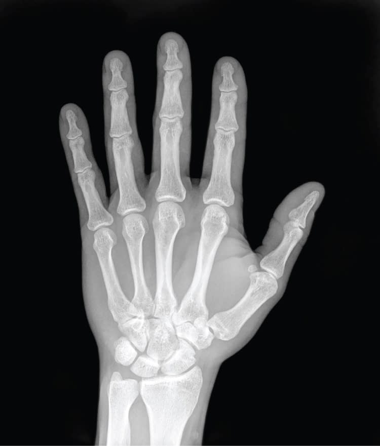 Ask An Orthopedist | Fractured Finger