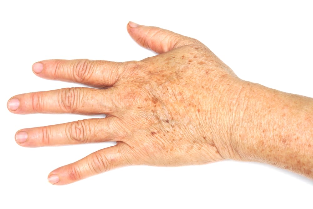 Are my dark spots associated with my Arthritis?