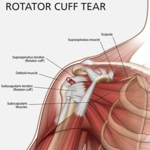 rotator-cuff-tear