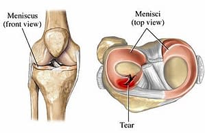 Torn Meniscus in Knee