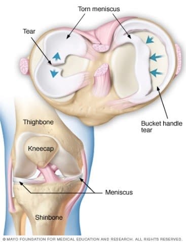 Ask An Orthopedist: Bucket-Handle Tear Of The Medial Meniscus ...