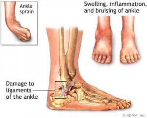 Ankle Sprain