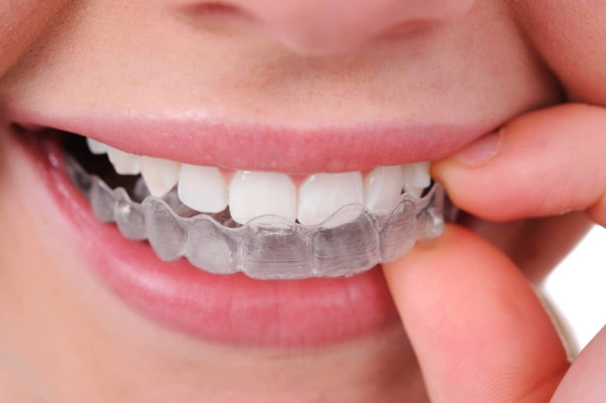 Which Is Better Braces Or Invisalign?