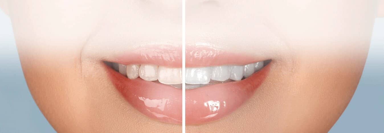 Before and after cosmetic dentistry comparison