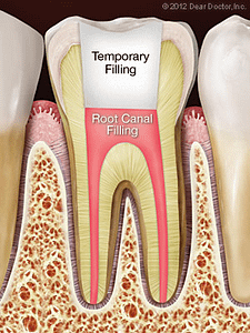 Tooth diagram showing a root canal filling and temporary filling from a root canal procedure.