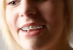 getty_rm_photo_of_girl_with_braces