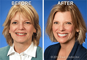 Before and after cosmetic dentistry results showing improved smile alignment and whitening.