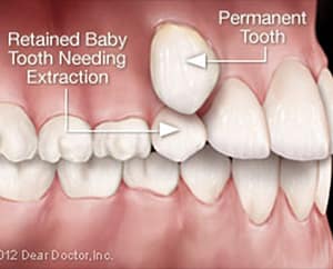Diagram of retained baby tooth requiring extraction with permanent tooth eruption, illustrating pediatric dental treatment and tooth development.