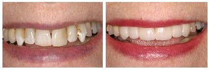 Green Bay Dentists | Before/After | Oral Health Associates