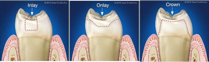 Dental Inlays and Onlays: Cosmetic Dental Services By OHA