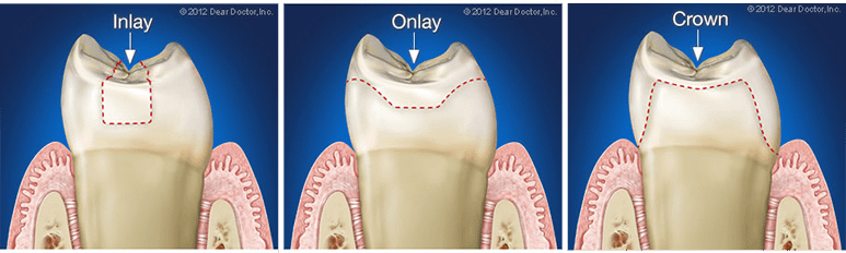 Dental diagram comparing inlay, onlay, and crown restorations, illustrating treatment options for repairing damaged or decayed teeth.