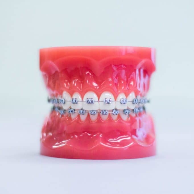 Metal braces